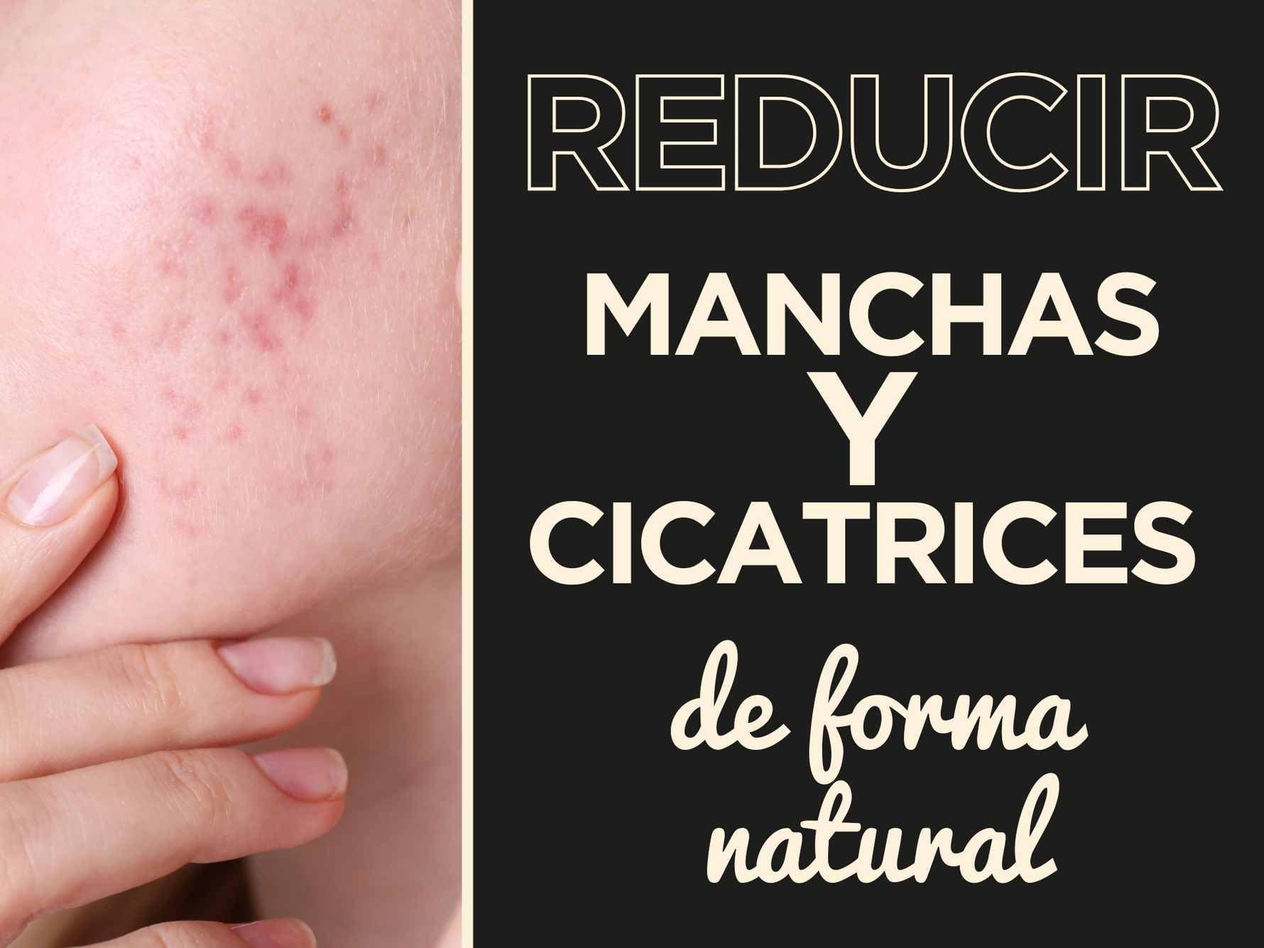 Manchas faciales: reduce cicatrices de forma natural